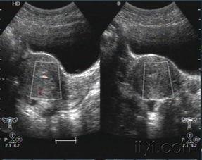 打胎的照片,打胎手术的瞬间纪实